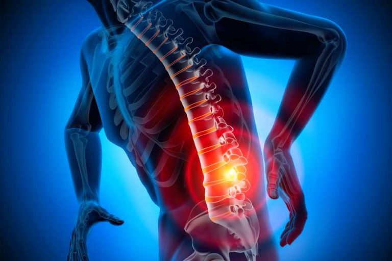 Can You Train BJJ With A Herniated Disc? BJJ Training Tips